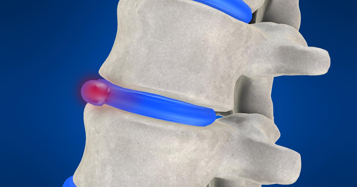 Denton, TX non-surgical disc herniation treatment